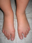 piedsgonfles